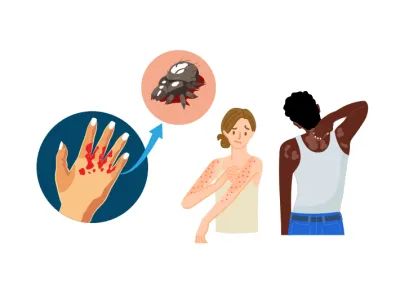 White background with a hand with blood on it, a mite and two people scratching bug bites.